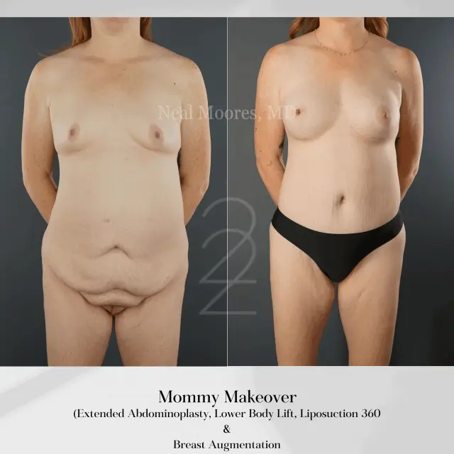 Mommy Makeover result at 22 Plastic Surgery & Spa MD in Cottonwood Heights, UT