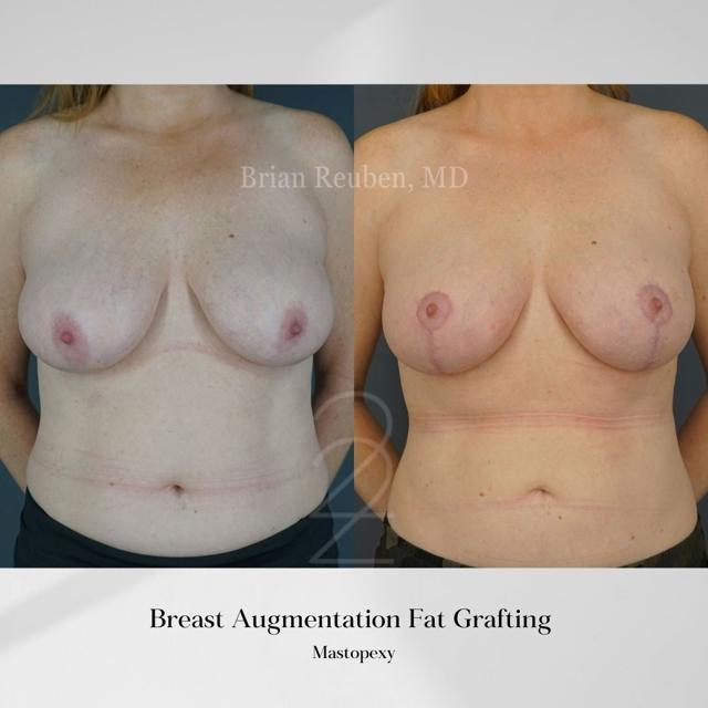Fat Transfer result at 22 Plastic Surgery & Spa MD in Cottonwood Heights, UT