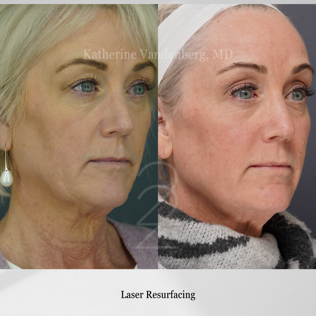Laser Skin Resurfacing result at 22 Plastic Surgery & Spa MD in Cottonwood Heights, UT