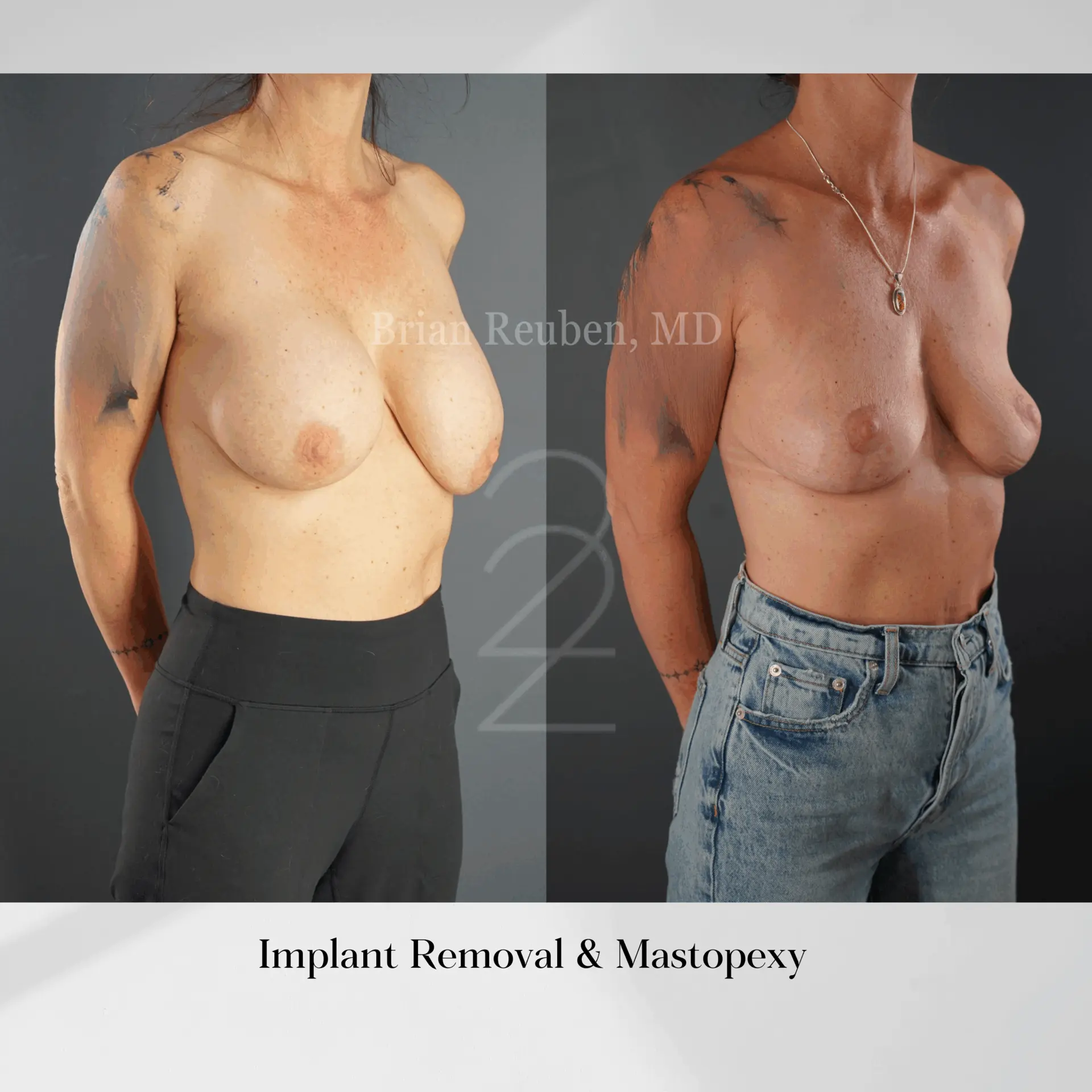 22 Plastic Surgery & Spa MD breast implant removal result — Cottonwood Heights, UT