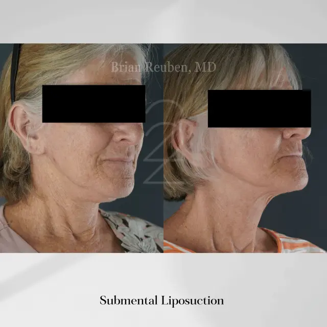 Liposuction result at 22 Plastic Surgery & Spa MD in Cottonwood Heights, UT