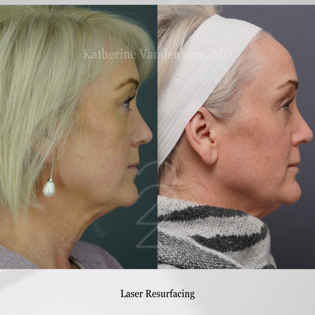 Laser Skin Resurfacing result at 22 Plastic Surgery & Spa MD in Cottonwood Heights, UT