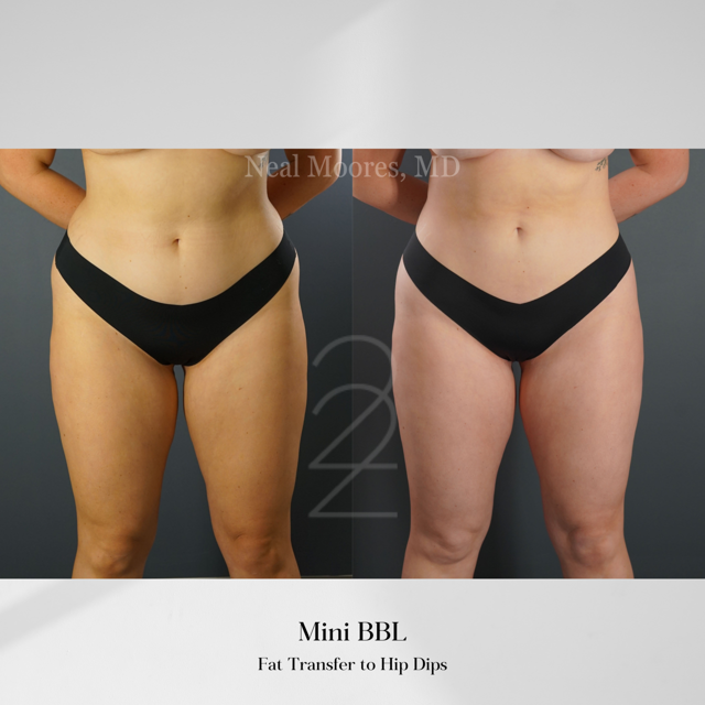Brazilian Butt Lift result at 22 Plastic Surgery & Spa MD in Cottonwood Heights, UT
