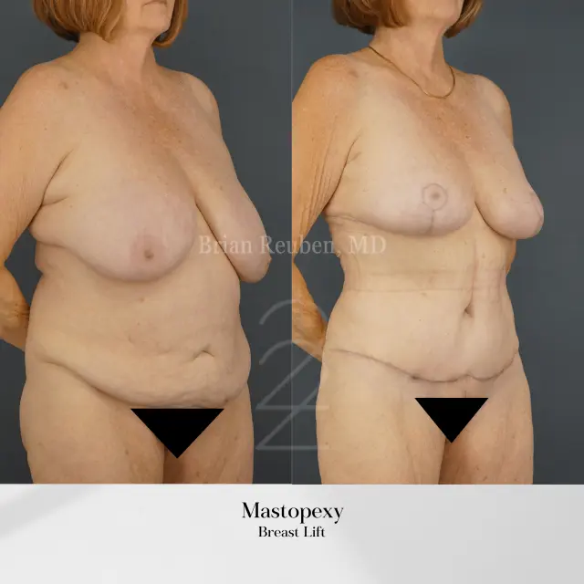 Breast Lift result at 22 Plastic Surgery & Spa MD in Cottonwood Heights, UT