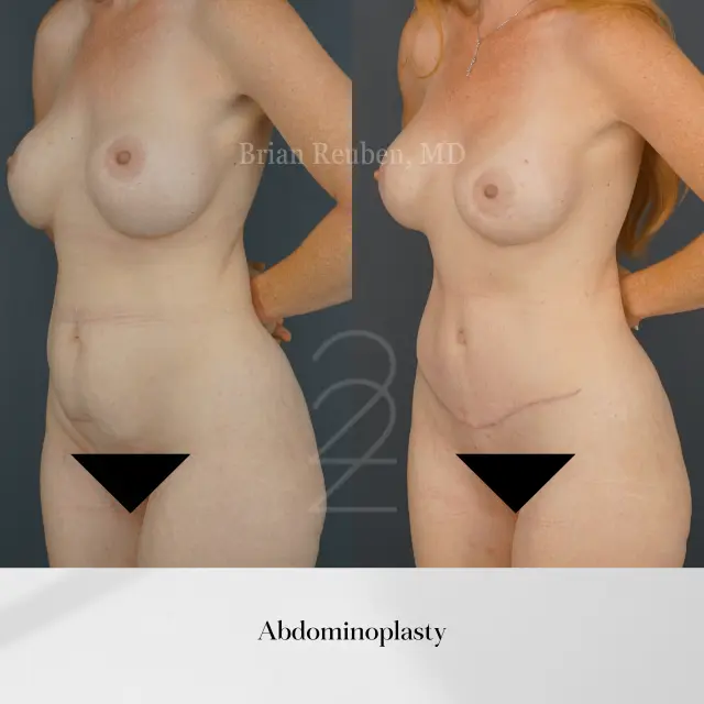 Tummy Tuck result at 22 Plastic Surgery & Spa MD in Cottonwood Heights, UT