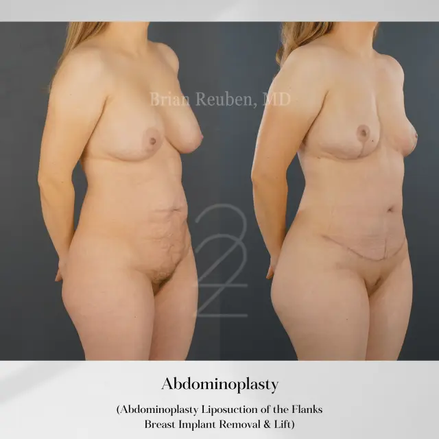 Tummy Tuck result at 22 Plastic Surgery & Spa MD in Cottonwood Heights, UT