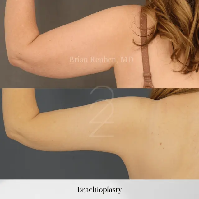 Arm Lift result at 22 Plastic Surgery & Spa MD in Cottonwood Heights, UT