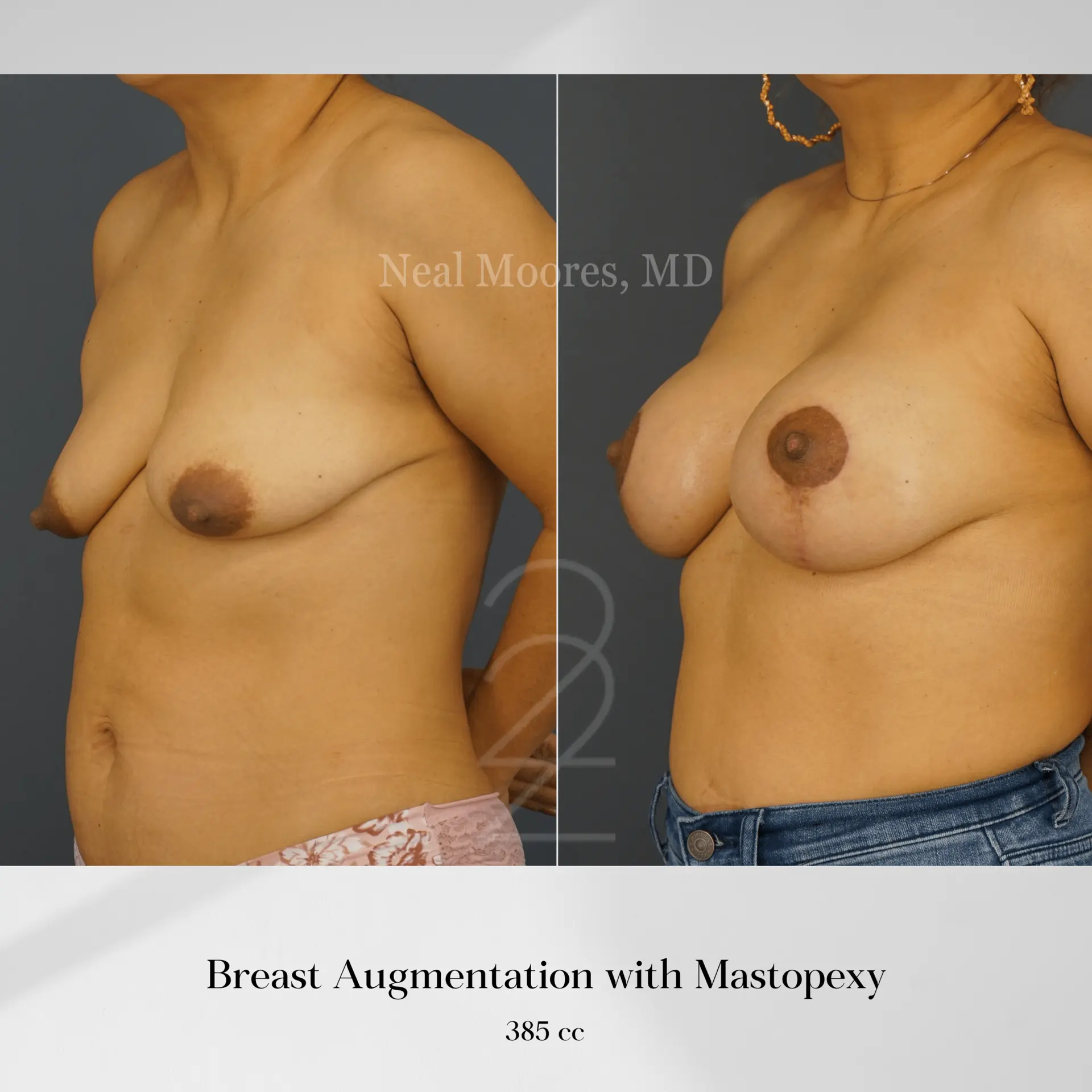 22 Plastic Surgery & Spa MD breast augmentation result — Cottonwood Heights, UT