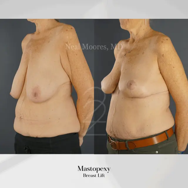 Breast Lift result at 22 Plastic Surgery & Spa MD in Cottonwood Heights, UT