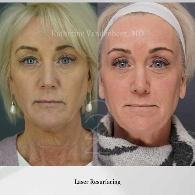 Laser Skin Resurfacing result at 22 Plastic Surgery & Spa MD in Cottonwood Heights, UT