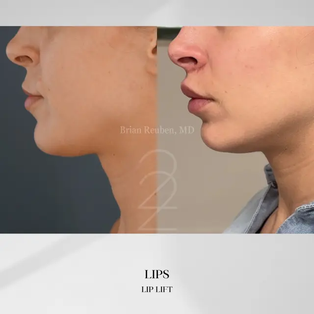 Lip Filler result at 22 Plastic Surgery & Spa MD in Cottonwood Heights, UT