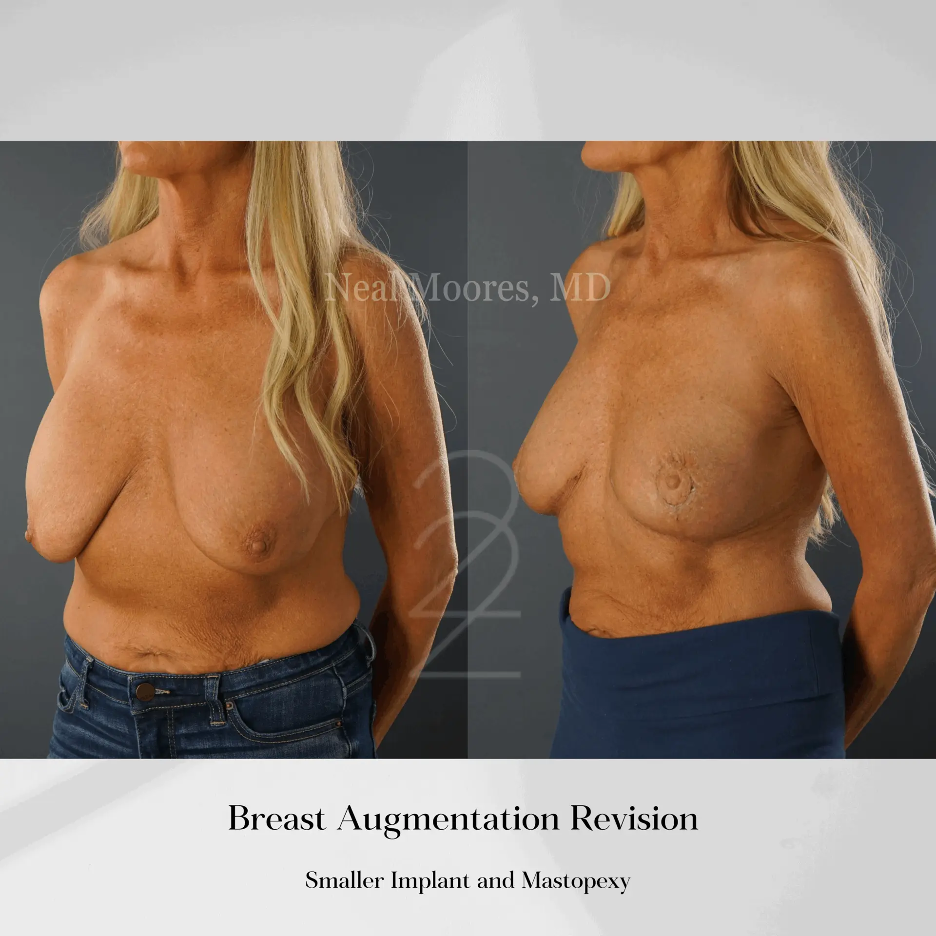 22 Plastic Surgery & Spa MD breast augmentation revision result — Cottonwood Heights, UT