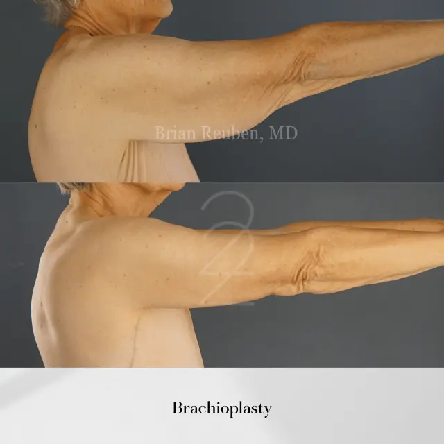 Arm Lift result at 22 Plastic Surgery & Spa MD in Cottonwood Heights, UT