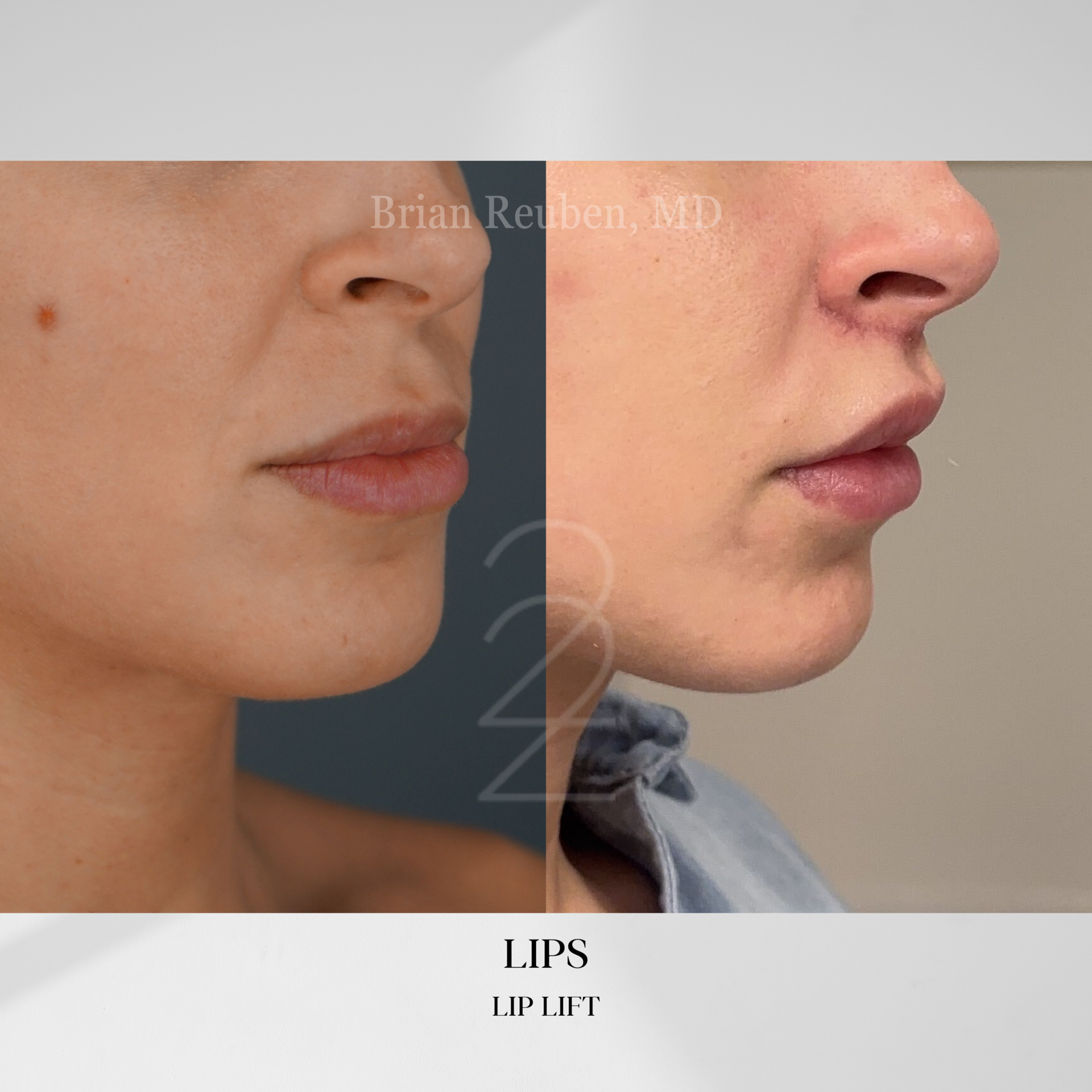 22 Plastic Surgery & Spa MD lip filler result — Cottonwood Heights, UT