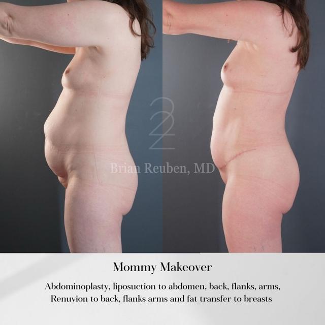 Mommy Makeover result at 22 Plastic Surgery & Spa MD in Cottonwood Heights, UT