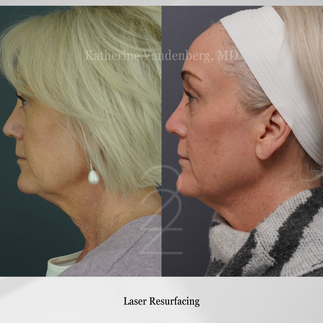 Laser Skin Resurfacing result at 22 Plastic Surgery & Spa MD in Cottonwood Heights, UT