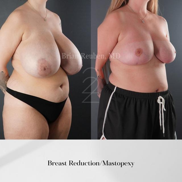 Breast Lift result at 22 Plastic Surgery & Spa MD in Cottonwood Heights, UT