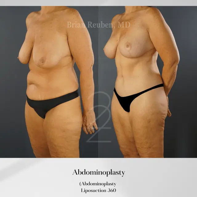Tummy Tuck result at 22 Plastic Surgery & Spa MD in Cottonwood Heights, UT