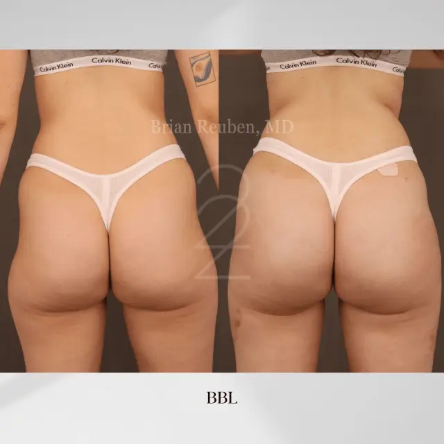 Brazilian Butt Lift result at 22 Plastic Surgery & Spa MD in Cottonwood Heights, UT