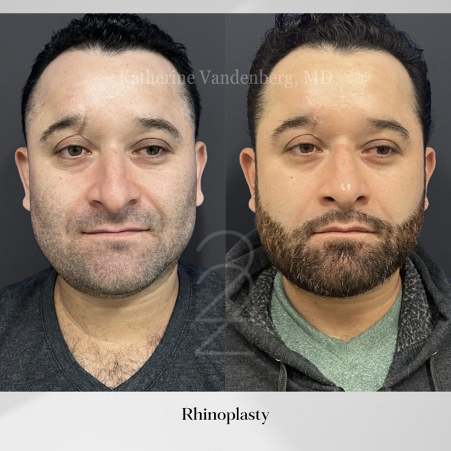 Rhinoplasty result at 22 Plastic Surgery & Spa MD in Cottonwood Heights, UT