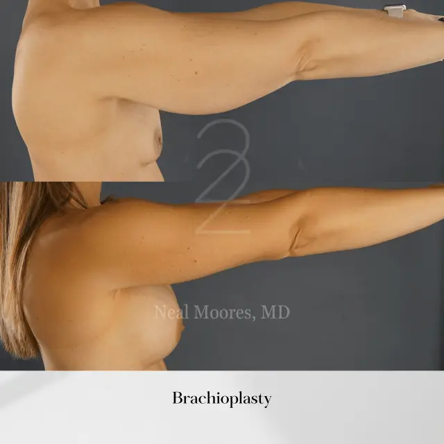 Arm Lift result at 22 Plastic Surgery & Spa MD in Cottonwood Heights, UT