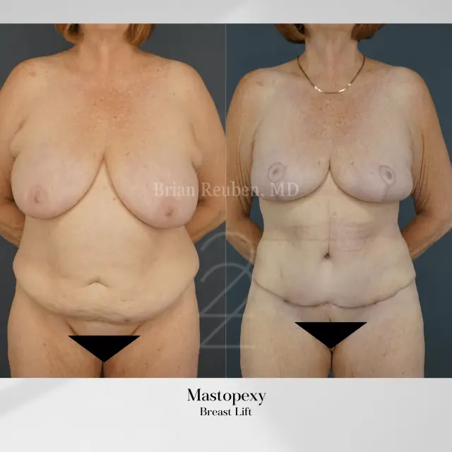 Breast Lift result at 22 Plastic Surgery & Spa MD in Cottonwood Heights, UT