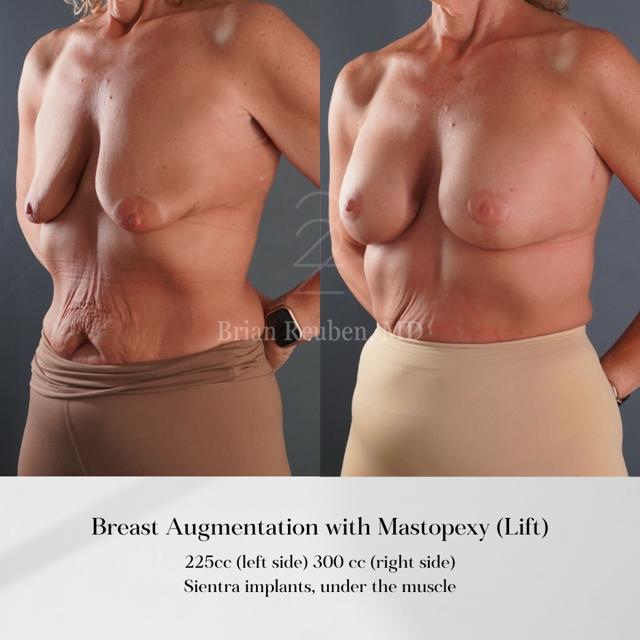 Breast Augmentation result at 22 Plastic Surgery & Spa MD in Cottonwood Heights, UT