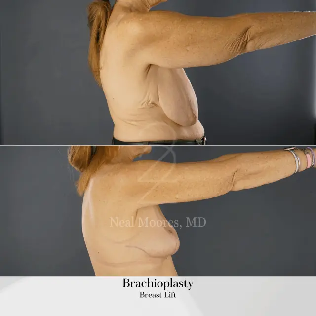 Arm Lift result at 22 Plastic Surgery & Spa MD in Cottonwood Heights, UT