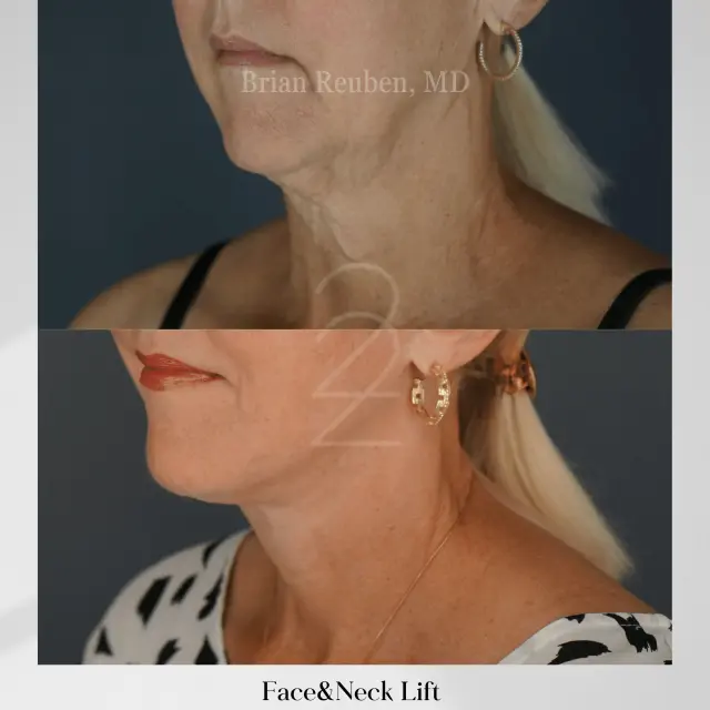 Facelift result at 22 Plastic Surgery & Spa MD in Cottonwood Heights, UT