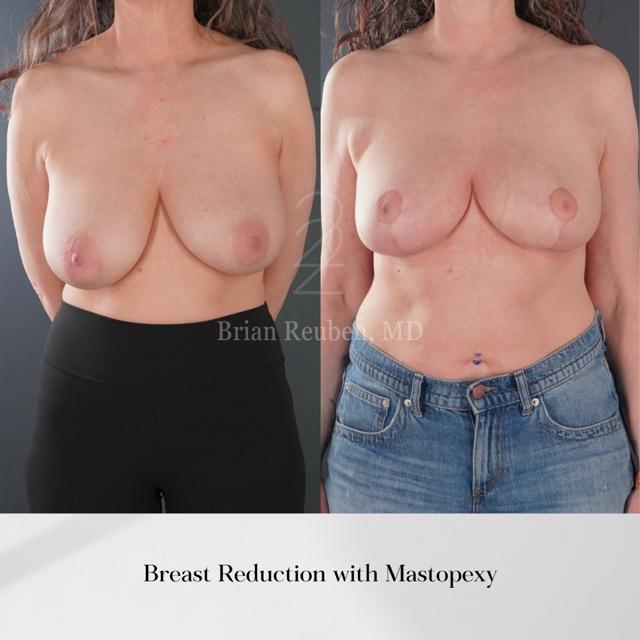Breast Reduction result at 22 Plastic Surgery & Spa MD in Cottonwood Heights, UT