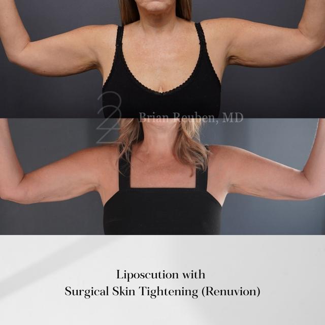 Liposuction result at 22 Plastic Surgery & Spa MD in Cottonwood Heights, UT