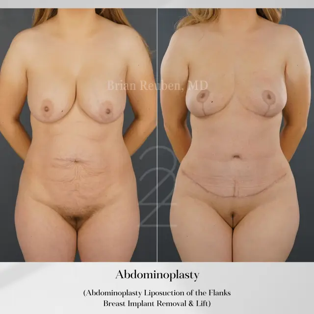 Tummy Tuck result at 22 Plastic Surgery & Spa MD in Cottonwood Heights, UT