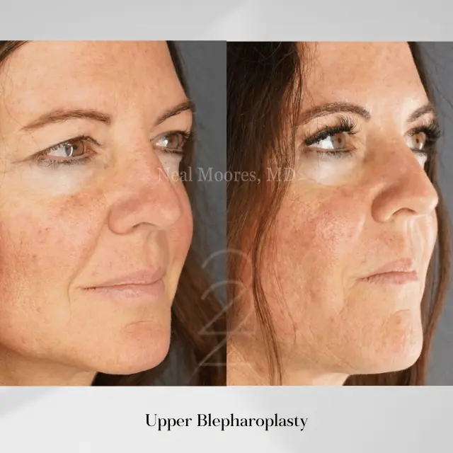 Blepharoplasty result at 22 Plastic Surgery & Spa MD in Cottonwood Heights, UT