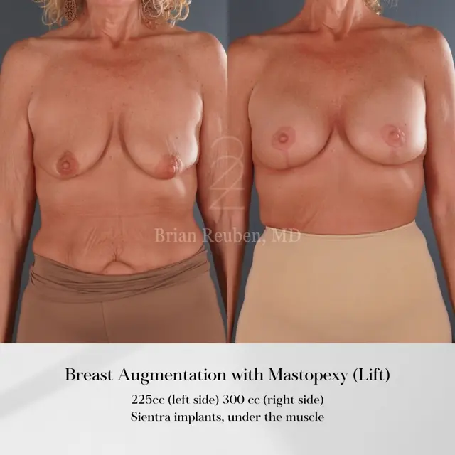 Breast Augmentation result at 22 Plastic Surgery & Spa MD in Cottonwood Heights, UT