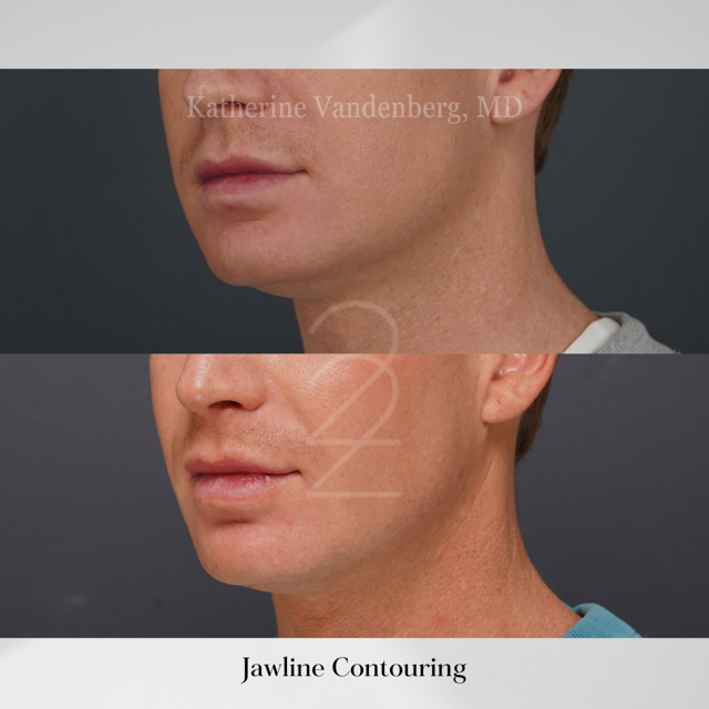 Lip Filler result at 22 Plastic Surgery & Spa MD in Cottonwood Heights, UT