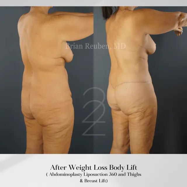 Thigh Lift result at 22 Plastic Surgery & Spa MD in Cottonwood Heights, UT