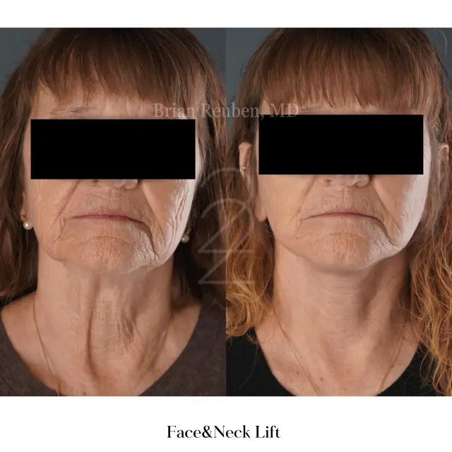 Facelift result at 22 Plastic Surgery & Spa MD in Cottonwood Heights, UT