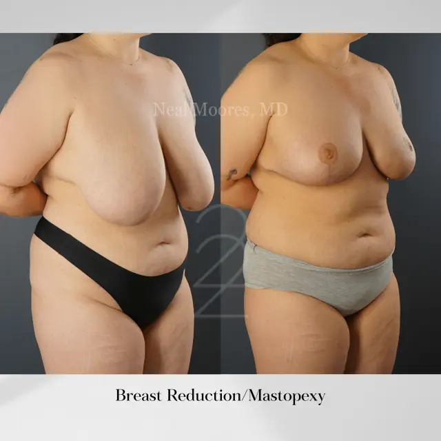 Breast Reduction result at 22 Plastic Surgery & Spa MD in Cottonwood Heights, UT