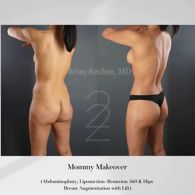 Mommy Makeover result at 22 Plastic Surgery & Spa MD in Cottonwood Heights, UT
