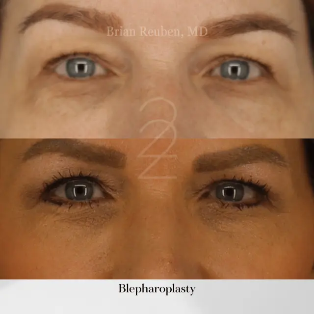 Blepharoplasty result at 22 Plastic Surgery & Spa MD in Cottonwood Heights, UT