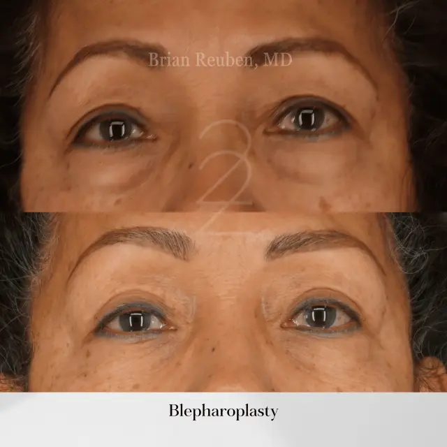 Blepharoplasty result at 22 Plastic Surgery & Spa MD in Cottonwood Heights, UT