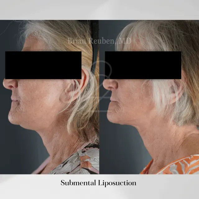 Liposuction result at 22 Plastic Surgery & Spa MD in Cottonwood Heights, UT