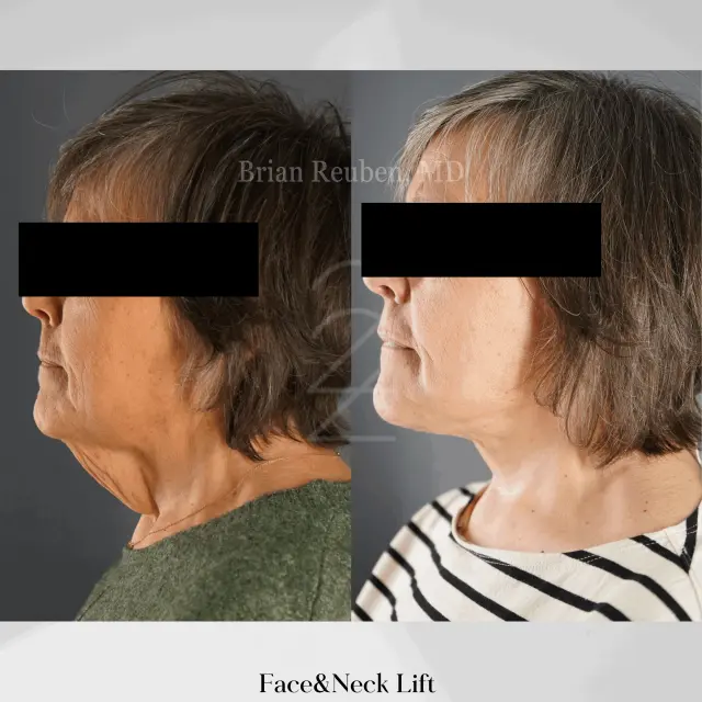 Facelift result at 22 Plastic Surgery & Spa MD in Cottonwood Heights, UT