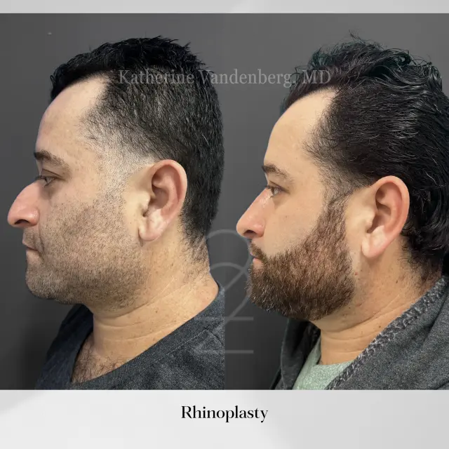 Rhinoplasty result at 22 Plastic Surgery & Spa MD in Cottonwood Heights, UT