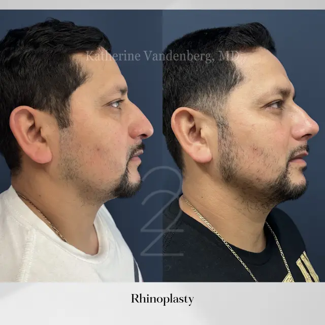 Rhinoplasty result at 22 Plastic Surgery & Spa MD in Cottonwood Heights, UT