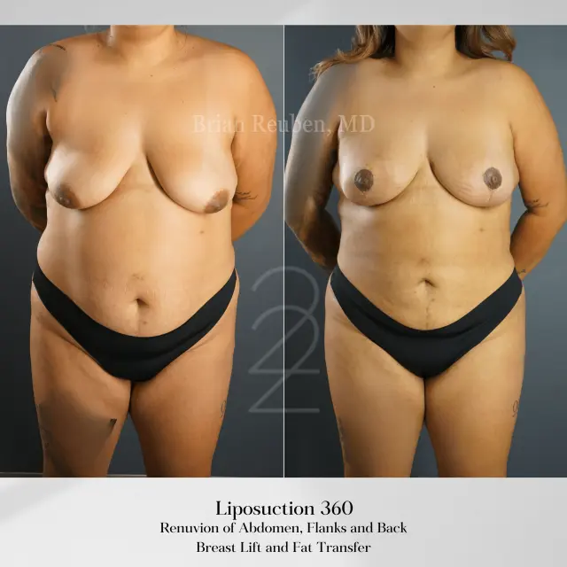 Liposuction result at 22 Plastic Surgery & Spa MD in Cottonwood Heights, UT