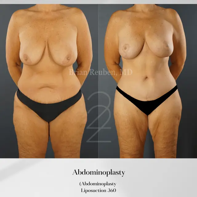 Tummy Tuck result at 22 Plastic Surgery & Spa MD in Cottonwood Heights, UT