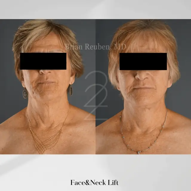 Facelift result at 22 Plastic Surgery & Spa MD in Cottonwood Heights, UT