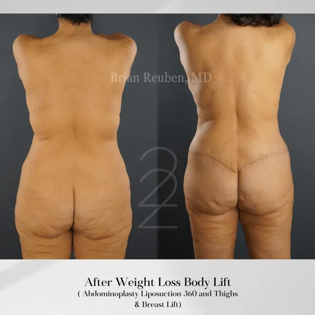 Thigh Lift result at 22 Plastic Surgery & Spa MD in Cottonwood Heights, UT