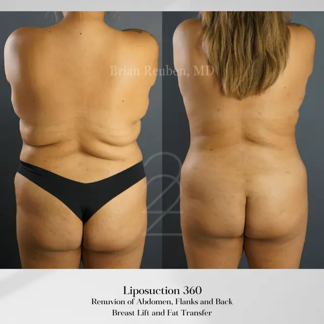 Liposuction result at 22 Plastic Surgery & Spa MD in Cottonwood Heights, UT